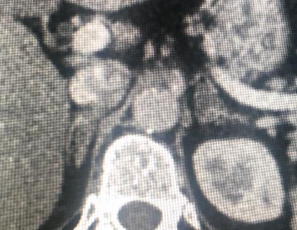 What are the CT findings?