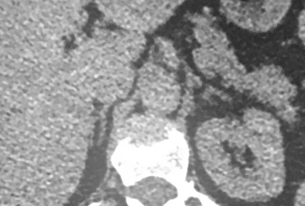 contour of left adrenal? Working diagnosis?