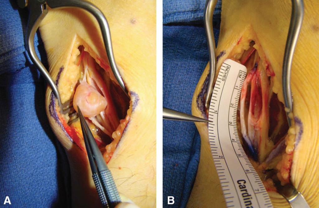 Allograft A, Peripheral nerve tumor requiring excision of associated fascicle.