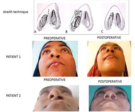 Jacob John et al., Management of Commonly Encountered Secondary Cleft Deformities of Face A Case Series www.ijars.
