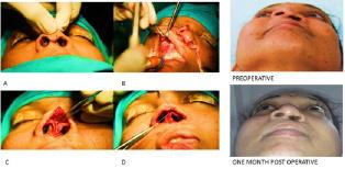 Patient gave a history of unilateral left complete cleft lip and palate, for which surgical correction of cleft lip was performed at the age of 10 weeks and for cleft palate at one year and nine