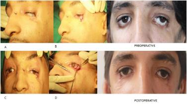 Jacob John et al., Management of Commonly Encountered Secondary Cleft Deformities of Face A Case Series www.ijars.net to close the eye lid completely.