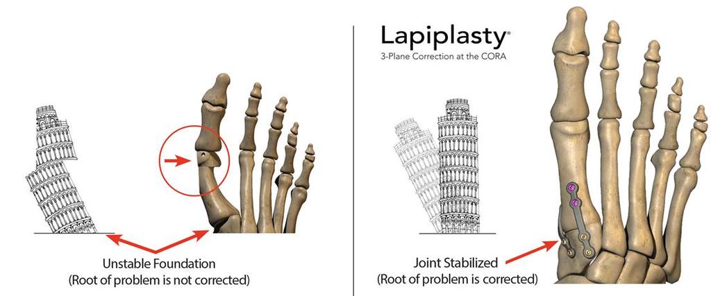 new paradigm that considers frontal plane rotation of the first metatarsal