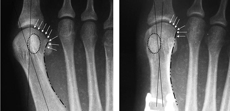 3 structural deformities present in a bunion must be corrected: the