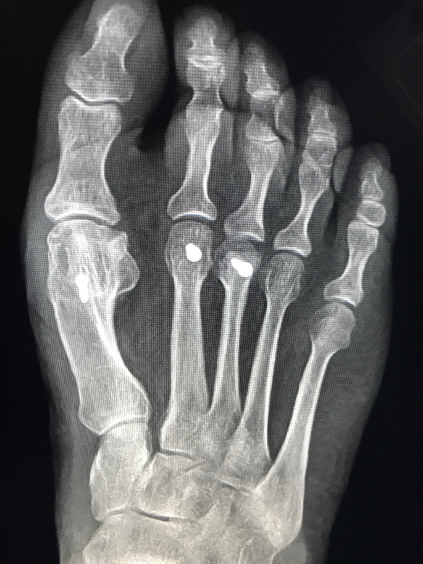 Risk Factors for Recurrence Recurrence risk factors implicate frontal-plane rotation Shibuya, J Foot Ankle Surg 2018: Incomplete sesamoid reduction Sravisht, FAI 2015: Pre-op severity & increased