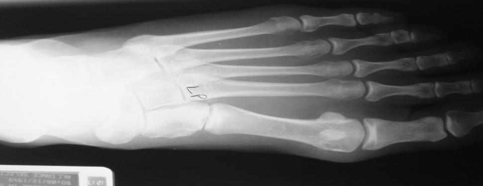metatarsal is deviated, not