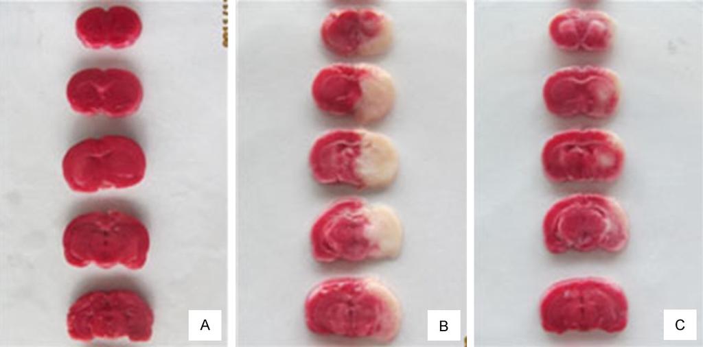 Figure 2. Representative pictures of TTC staining. A: Infarct volume of Sham (S) group. B: Infarct volume of ischemiareperfusion (IR) group. C: Infarct volume of Ulinastatin (U) treatment group.