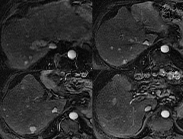 cm or multifocal tumor WITHOUT