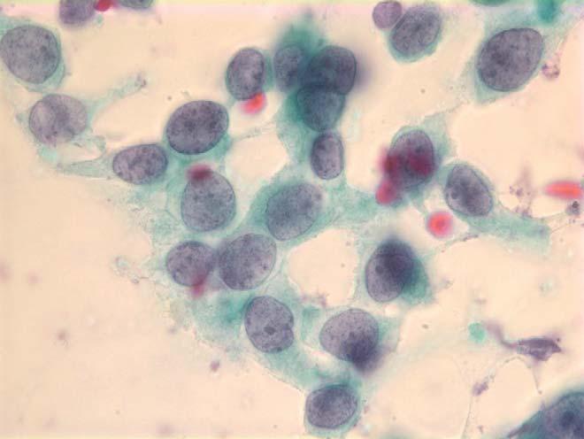 MATERIALS AND METHODS Fine-needle aspiration cytology 315 Fig. 1 Cells from a high-nuclear-grade DCIS. Original magnification 100; PAP. Fig. 2 Cells from a nonhigh (low)-nuclear-grade DCIS.