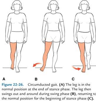 Antalgic gait... - Limping - Shortened stance phase on painful / affected limb Steppage gait.