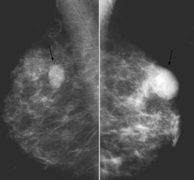 Caumo F et al / Radiologic-pathologic correlation of inflammatory breast cancer 277 Figures 2a, 2b. Inflammatory carcinoma, common presentation.