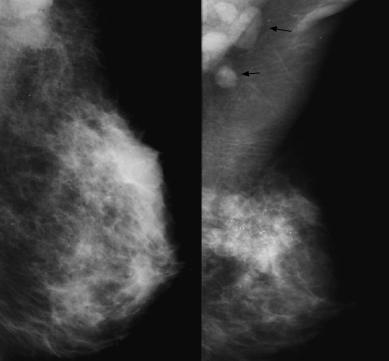 278 Caumo F et al / Radiologic-pathologic correlation of inflammatory breast cancer Figures 3a, 3b. Inflammatory carcinoma, uncommon presentation. (a) Mediolateral oblique left mammogram.