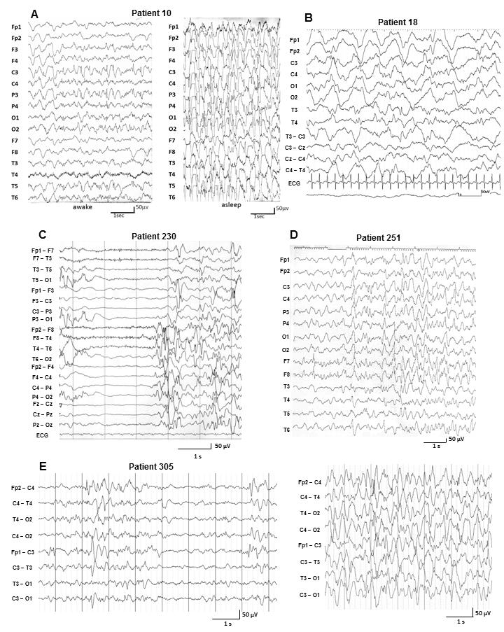 Figure e-2 Interictal EEG of patients with SCN2A mutations. (A) Patient 10 at 3 years and 2 months.