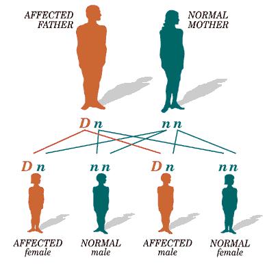 Achondroplasia Autosomal Dominant Defects in growth of long bones Form of dwarfism Short arms and legs but torso of normal size, large head compared to body