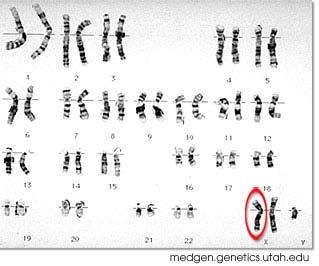 Turner Syndrome XO Female missing one X chromosome short stature wide neck with extra skin folds underdevelopment of sex characteristics may lead to sterility non-disjunction of sex chromosomes