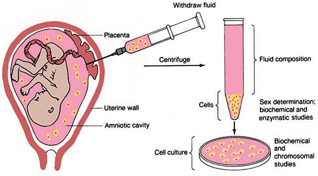 chemicals or defective fetal cells in the amniotic
