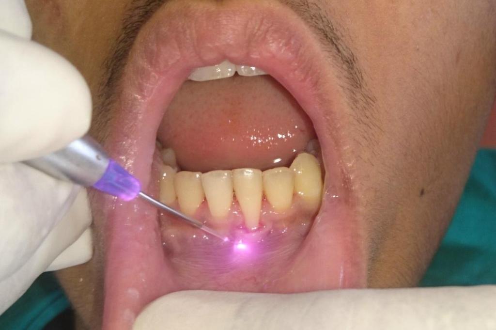 laser parameters. Root coverage procedure will be performed later. The rationale for choosing laser was to make minimal invasive site preparation.