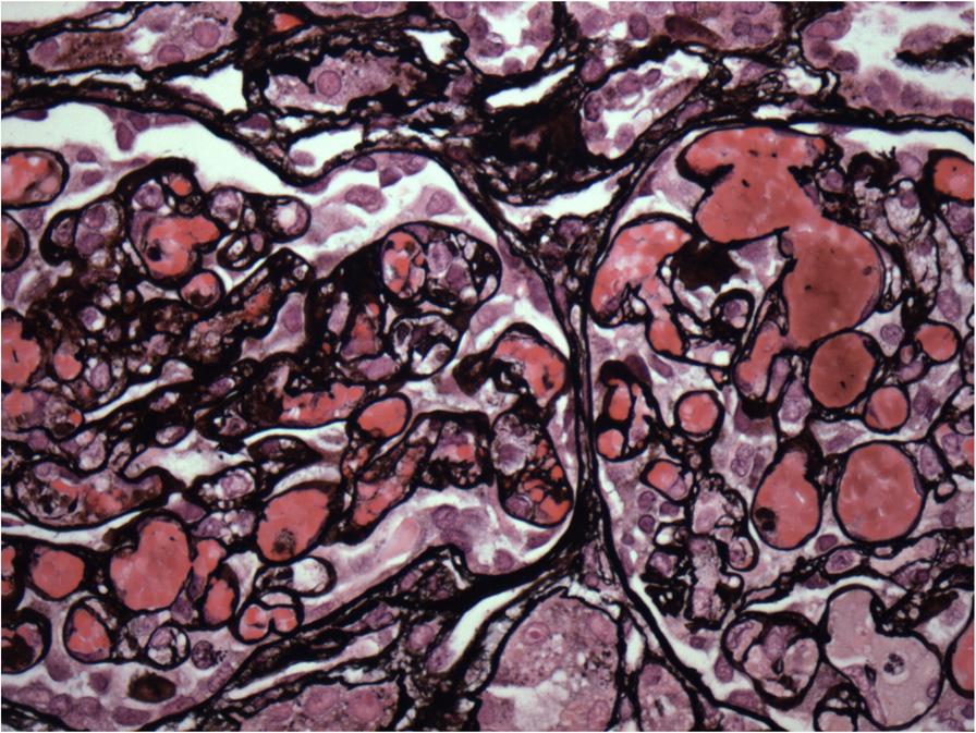 McCoy and Weaver BMC Pediatrics 2014, 14:278 Page 3 of 5 Figure 3 Jones stain showing fibrin thrombi and vascular congestion of glomeruli suggestive on hemolytic uremia syndrome. studies (Figure 1).