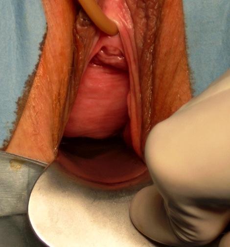 Descent of the pelvic organs