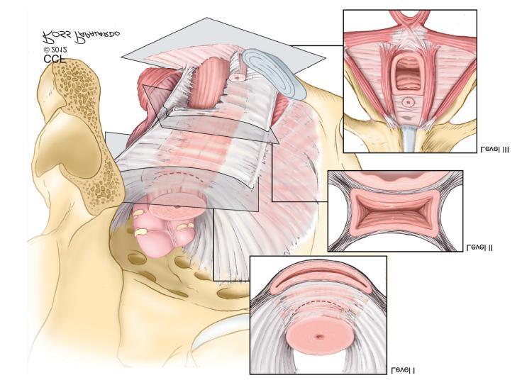 Pelvic organ prolapse Anatomical apects The maintain of pelvic floor, resultance of 3 systems Level 1 Suspension of vaginal apex Cardinal and sacro-uterine ligaments Level 2 Cohesion between vagina