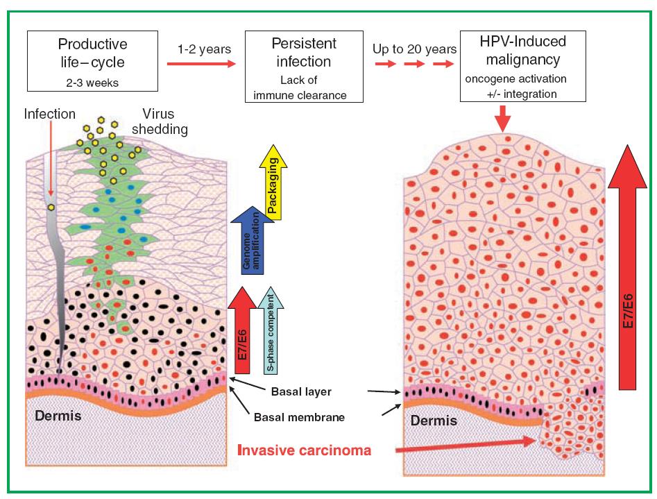 Progression from a productive high-risk HPV infection to malignancy M Thomas