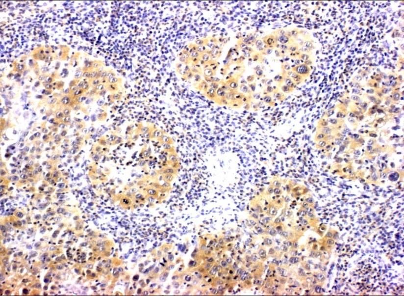 HPV-16 E7 is highly expressed in cervical