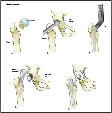 Hofmann Arthritis Institute Precision Joint Replacement 24 South 1100 East Suite 101 Salt Lake City, UT 84102 801-35-JOINT AFTER YOUR TOTAL HIP REPLACEMENT Your full recovery from your total hip