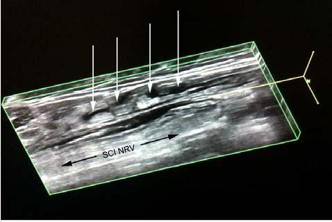 Extrafascial extravasation (*) is also seen adjacent to the complex fascial sheath of the nerve (arrows). Figure 3.