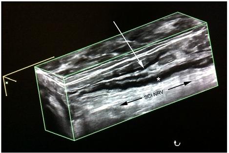 Figure 4. Post-block 3-D ultrasound scan along the longitudinal axis of the sciatic nerve (proximal to the popliteal fossa) showing real-time local anesthetic extravasation at the site of injection.
