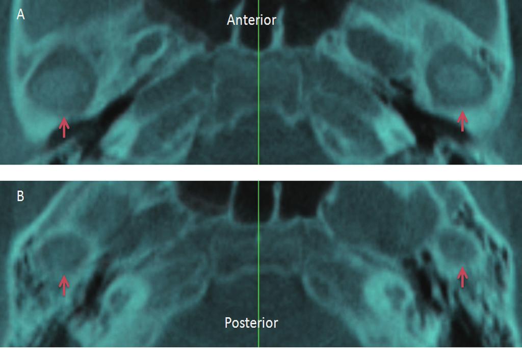 506 Fig. 5 Horizontal view of superimposition of T1 and T2 images registered on the anterior cranial base; T1 is shown in white and T2 in blue.