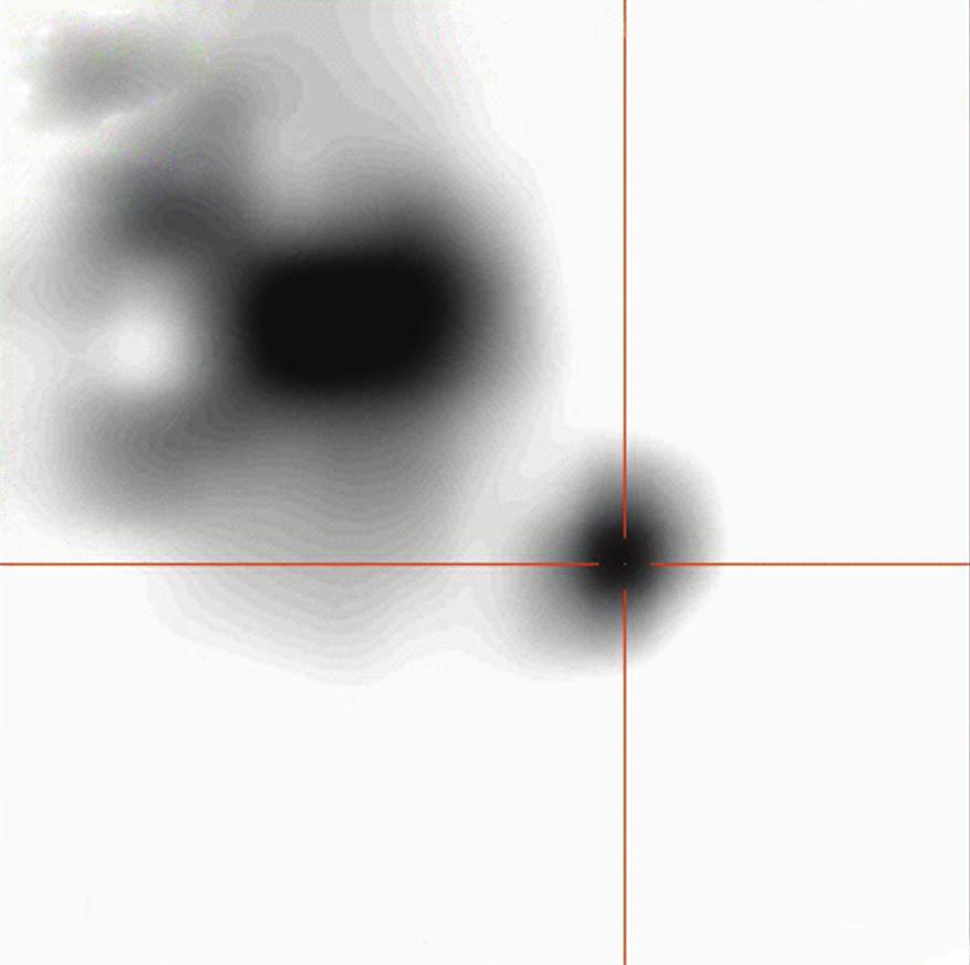 (a) shows the MIP (maximum intensity projection) image of SPECT acquisition in anteroposterior view.