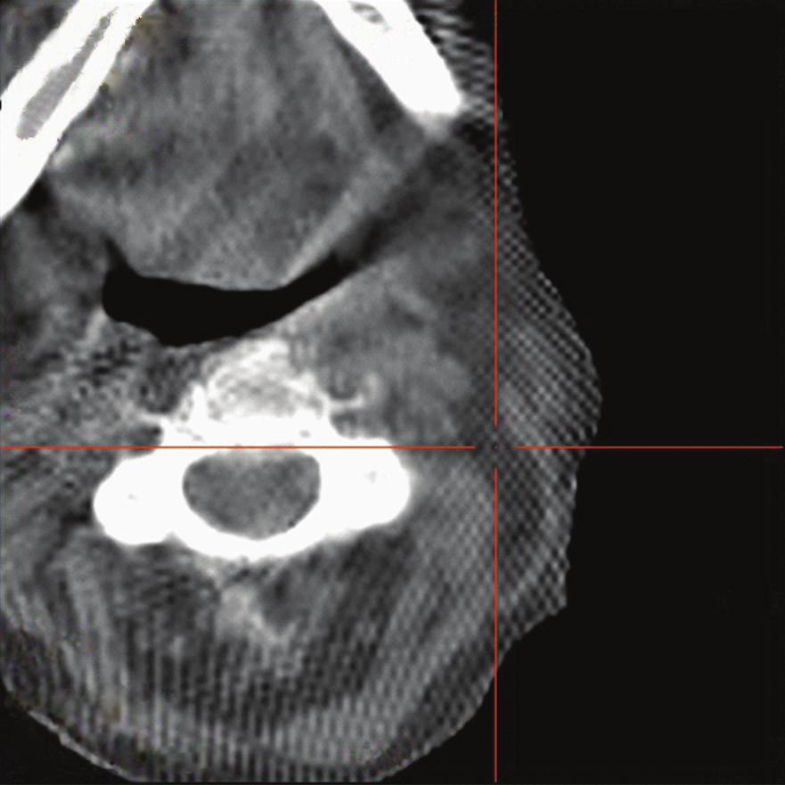 (b) shows a fused coronal SPECT/CT image that localises the small focal uptake in the neck region level IIA/B.