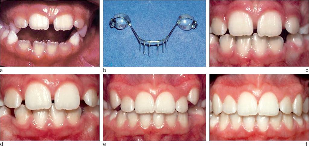 INTERVIEW WITH VINCENT KOKICH Figures 2 a to f If a patient has an anterior openbite with normal lip competence, and the maxillary incisors are positioned above the level of the upper lip (a), then