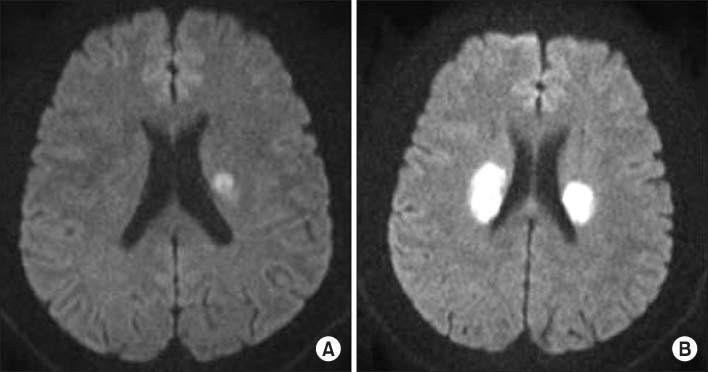 Location: Strategic Infarcts A single small infarct may cause severe deficits when located in a strategic brain region