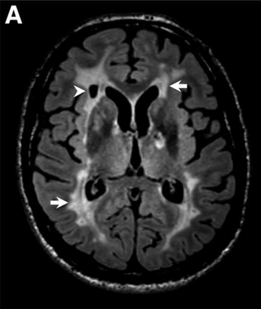 White Matter Lesions: Subcortical Ischemic VaD Microvascular ischemic disease is associated with lacunar infarct &