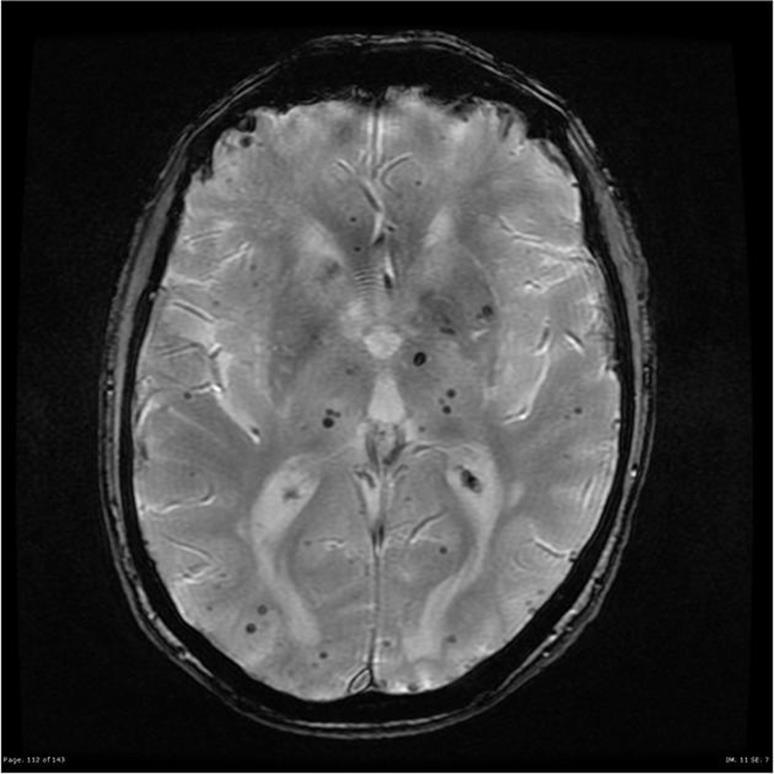 Cerebral Pathology: Cerebral Angiopathy Accumulation of cerebral amyloid-β (Aβ) in