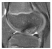 Physical Characteristics OCD or Focal Cartilage Defect Other Knee Features OCD