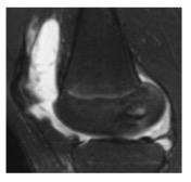 superior to the patella, but the length of luid layer < length of patella
