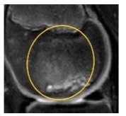 No Yes If present, measurement of largest focal area: T2 Sagittal Absent Present, single