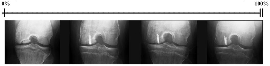 current stage of healing with respect to radiodensity: Totally radiolucent Same radiodensity as parent bone B.