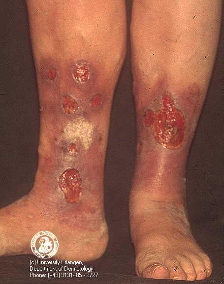 DVT is Dangerous Post thrombotic syndrome 60% following