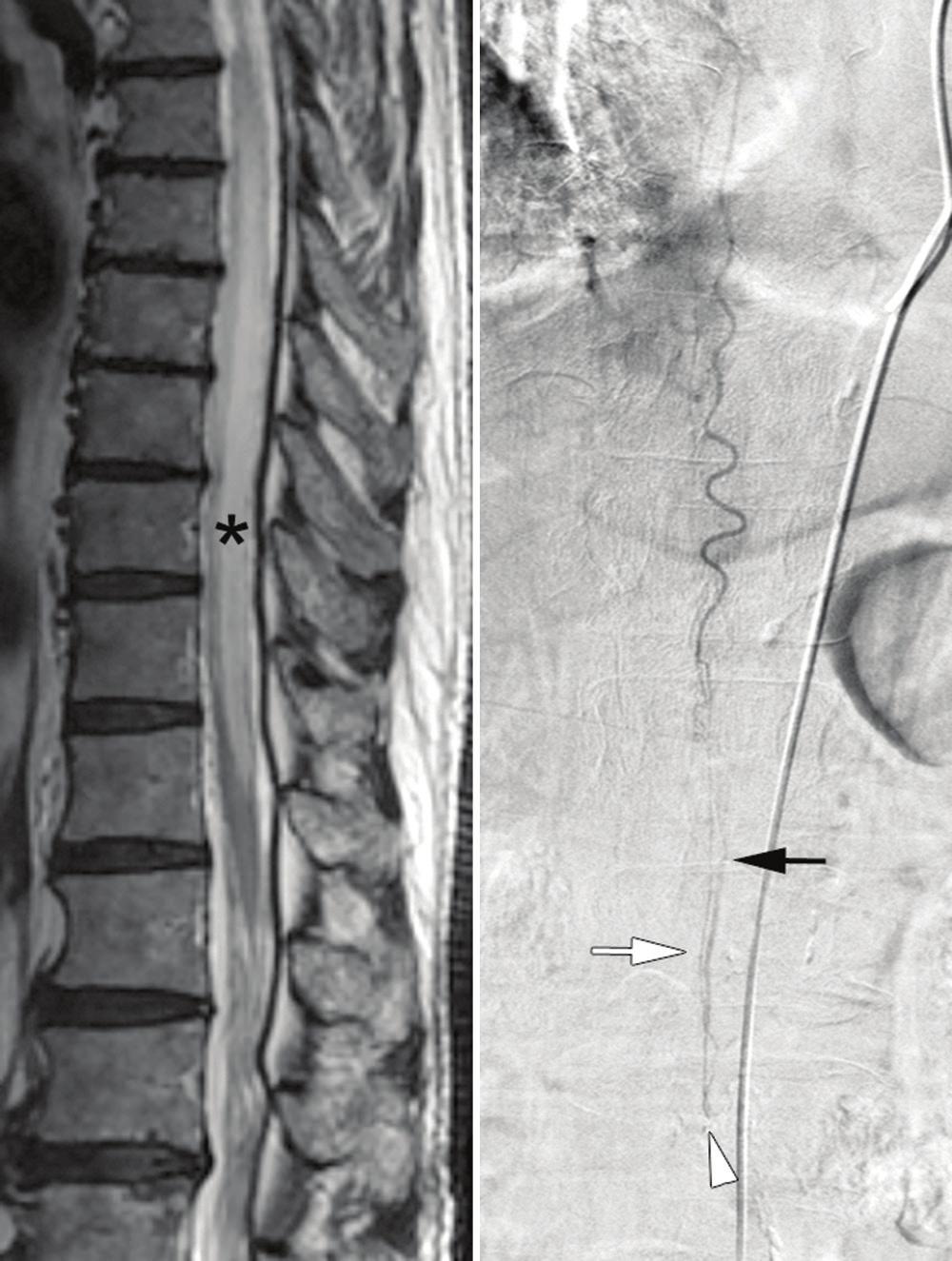 Historical Changes in the Classification of Spinal AV Shunts 359 feeder and single small AVF, Type II with multiple feeders and multiple medium AVFs, and Type III with multiple feeders and a single