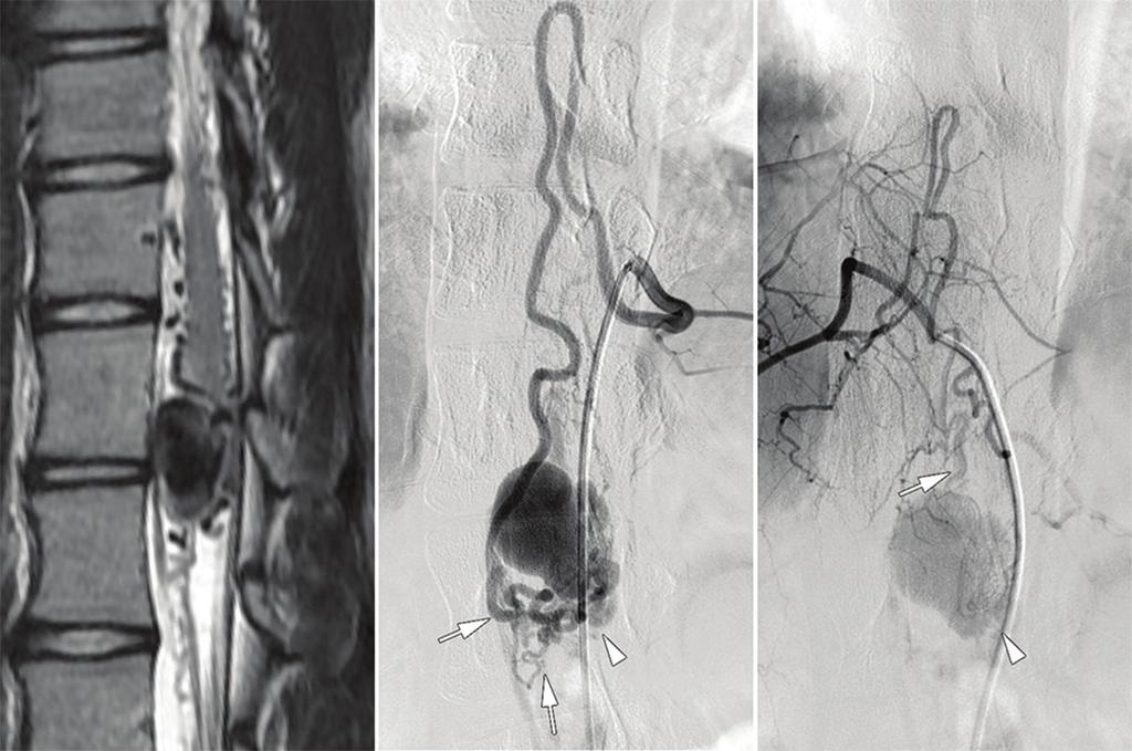 (B) An angiogram of the thoracic intercostal artery showing intradural perimedullary AVF subtype II (arrowhead) fed by pial branches of the anterior and posterior spinal arteries (arrows).
