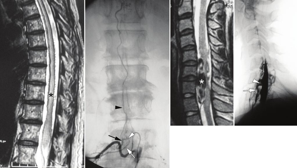 362 K. Takai of life and exhibited diffuse high signal intensity in the spinal cord on T2-weighted magnetic resonance (MR) images with no mass effect.