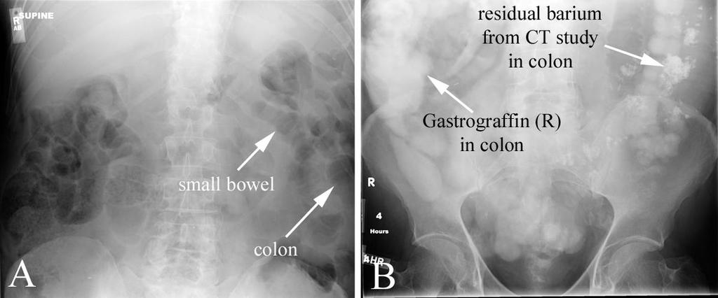 09/17/2011 Radiology Quiz of the Week # 38 Page 4 IMAGING STUDY QUESTIONS AND ANSWERS Answers to imaging questions: 1) The left panel (A) is the patient s abdominal plain film at the time of