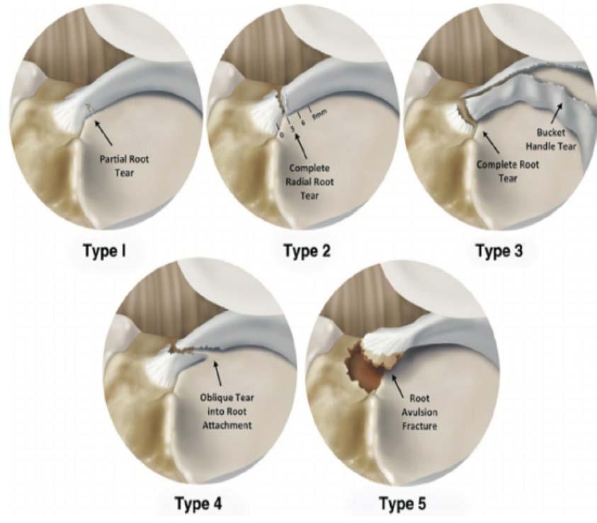 Classification of Posterior Root Type 4 complex oblique or longitudinal tear with
