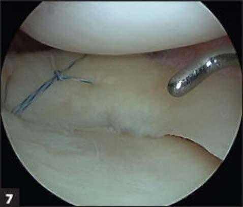 Suture Anchor Repair Advantages Does not require