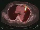 9 DX: pulmonary carcinoid Bronchoalveolar Carcinoma least common of the lung cancers 70 y/o with known ovarian CA and elevated CA-125