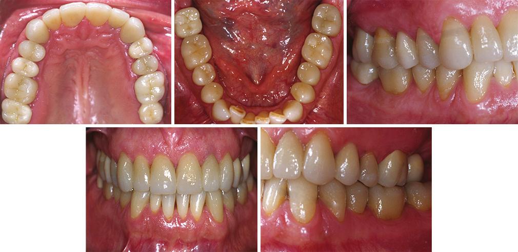 mx ZirCAD frmeworks were veneered with IPS e.mx Cerm (fluorptite veneering cermic). Specil cre ws given to the connector design of the single retined cntilever.