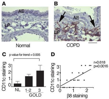 Figure 8 DCs are increased in the airway wall of COPD compared with normal patients, which correlates with disease severity and β8 integrin immunostaining.